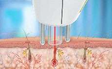  laser rapidly heats and destroys the hair follicle to prevent regrowth